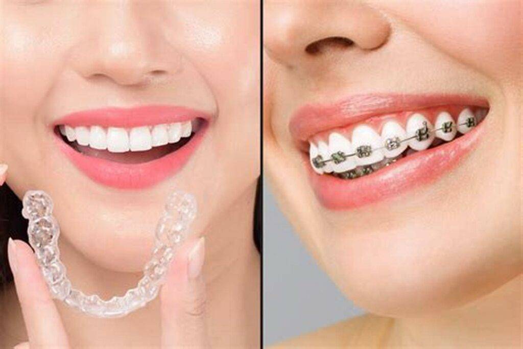 Braces & Aligners
